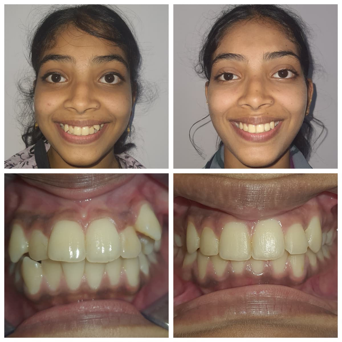 Before Fixed appliance