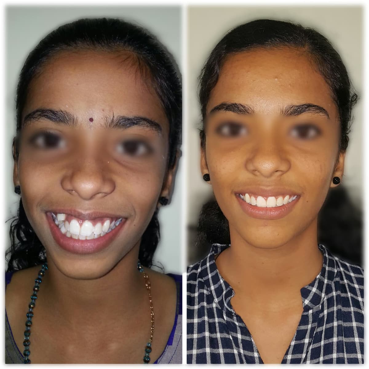 Before Fixed orthodontics gemini brackets