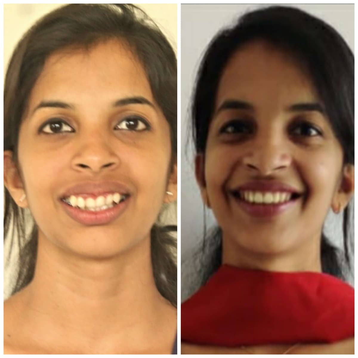 Before Fixed appliance